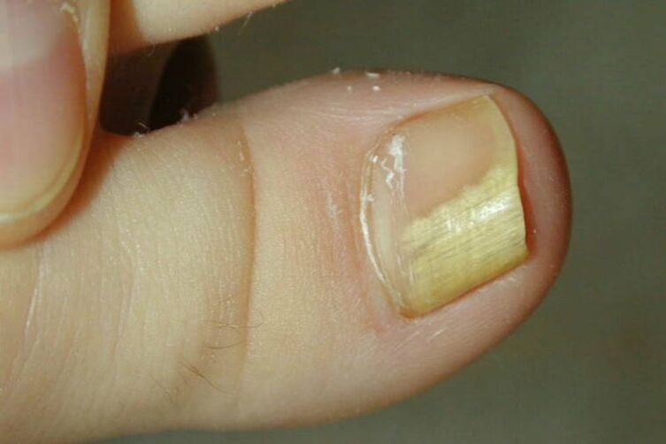 Symptoms of fungus on the thumb photo 1