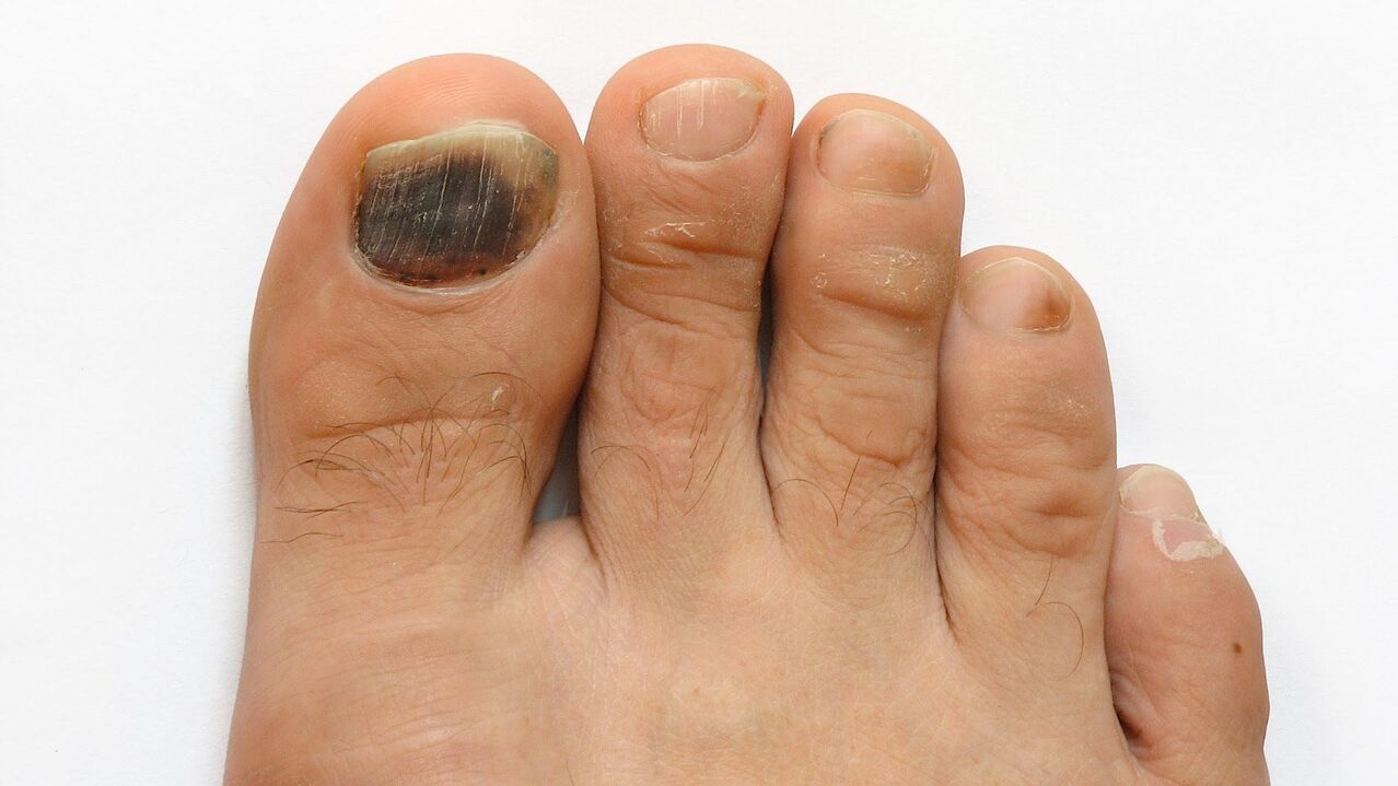 Symptoms of fungus on the thumb photo 2