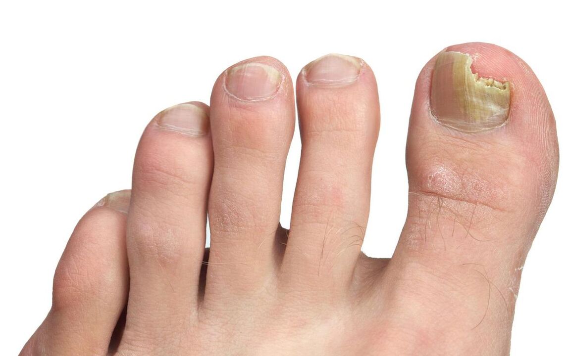 Symptoms of fungus on the thumb photo 3