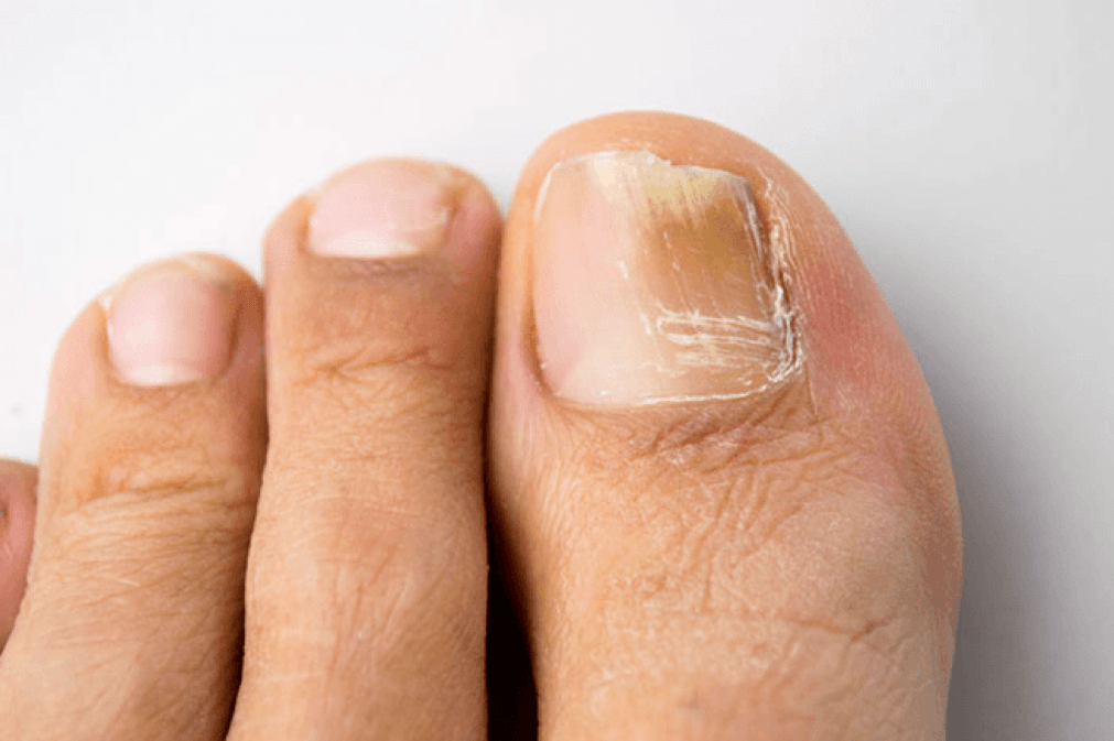 Symptoms of fungus on the thumb photo 4