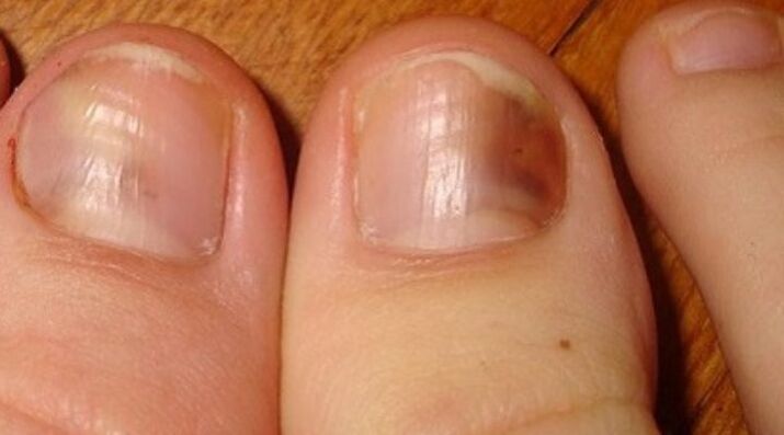 fungal infection of the nails