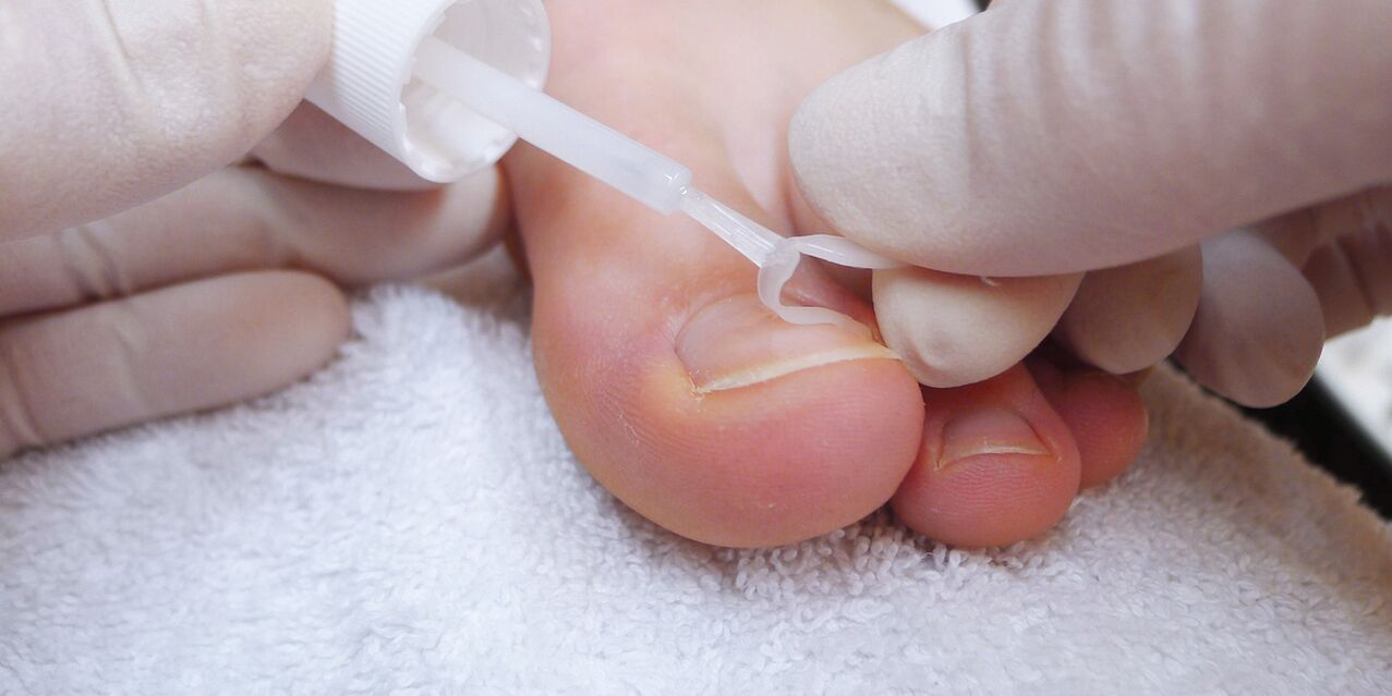 medicated nail fungus spray