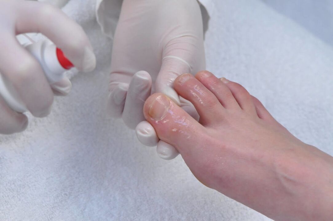 nail fungus treatment spray