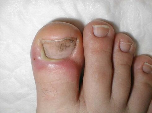 Treatment of spotted nail fungus