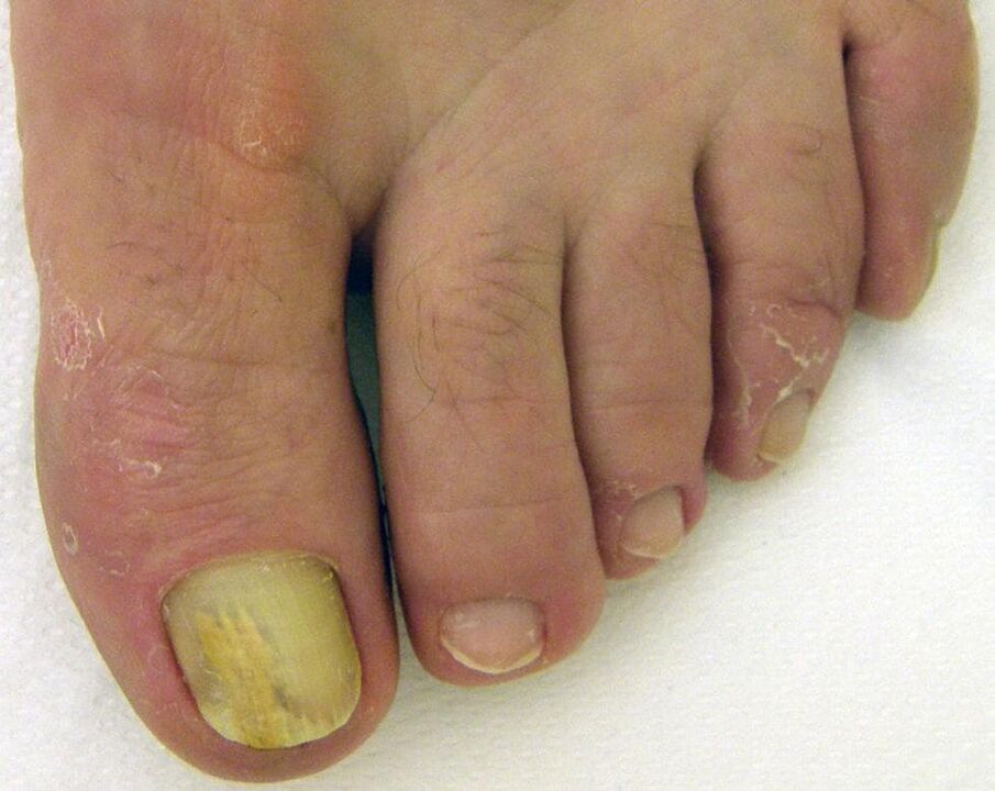 yellow nail with fungus how to treat spots
