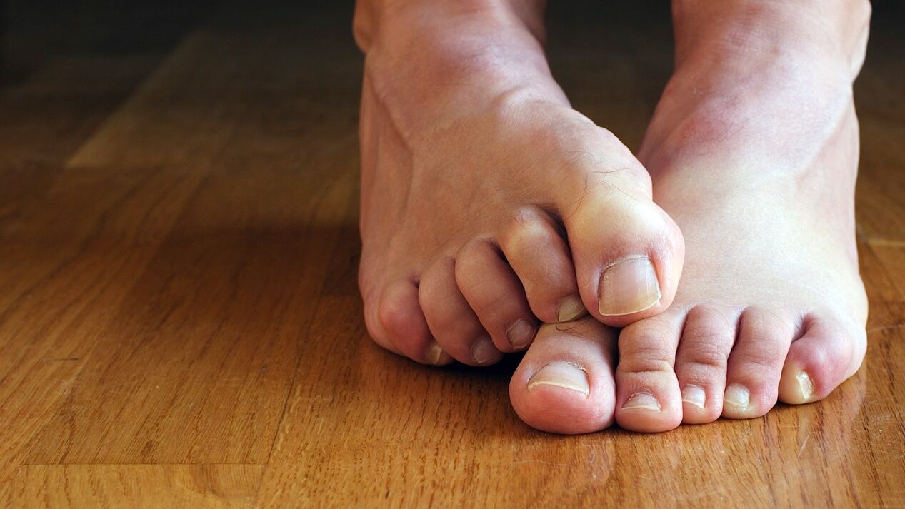 itching of the skin of the feet with a fungus