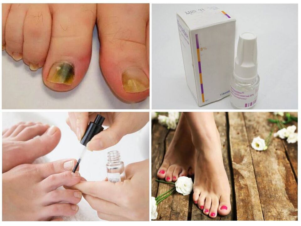 how to use anti fungal nail polishes