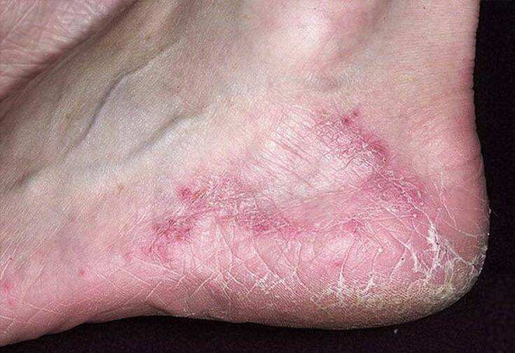 Cracks and reddening of the skin on the heels are signs of a fungal infection