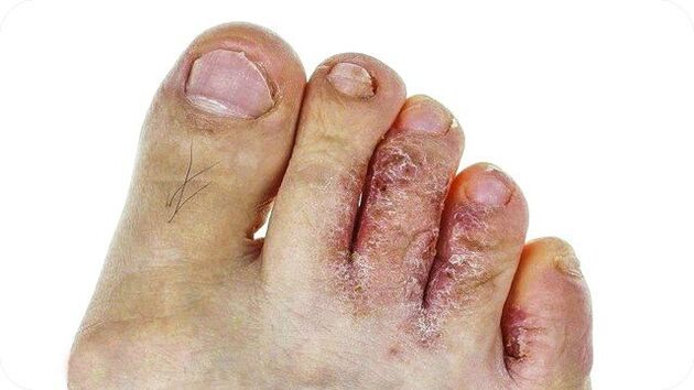 How do toenail fungus appear 