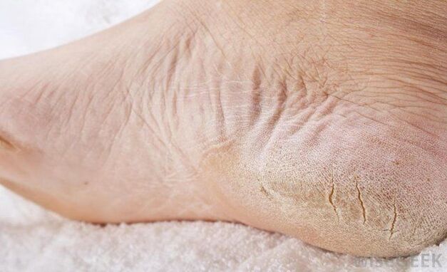dry feet is a sign of fungus