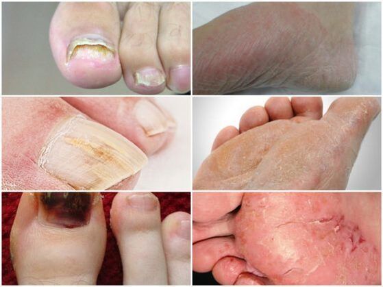what does foot mycosis look like 