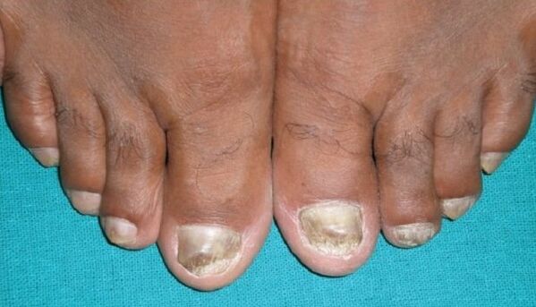 Fungi on the nails