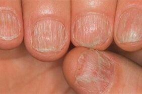 Fungal lesion