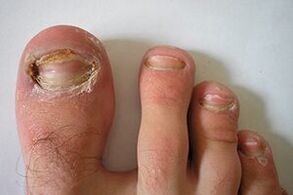 fungi on the nails