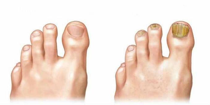 What the fungus looks like on the nails