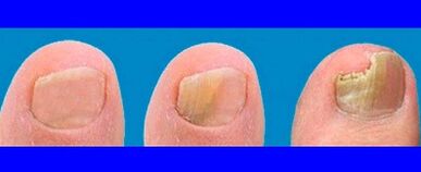 Stages of fungal development on fingers