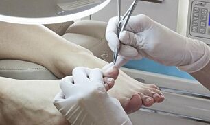 Surgical removal of the nail in the presence of a fungus