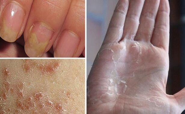 Can mycosis pass into other parts of the body
