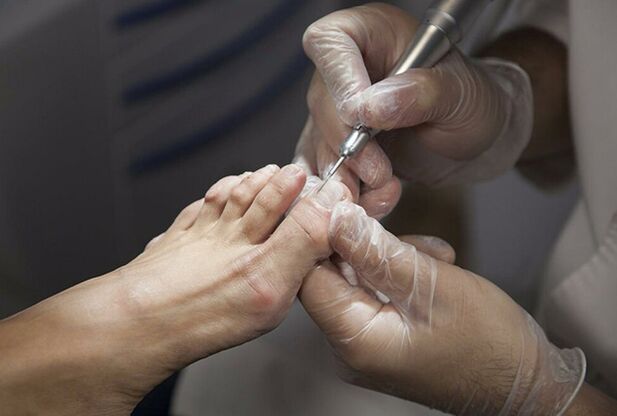 Diagnosis of fungi of the feet