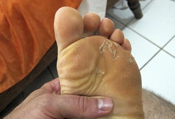 fungi on the skin of the feet
