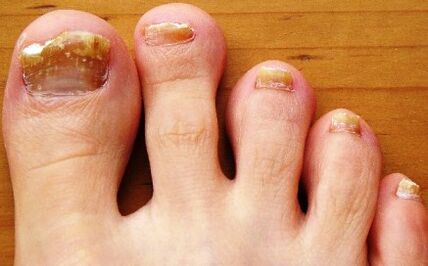 toenails affected by mold