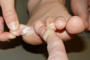 Fungus on the toes