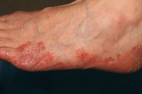 manifestations of fungus on the feet