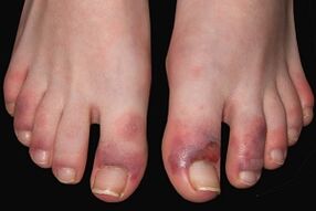 symptoms of fungus on fingers