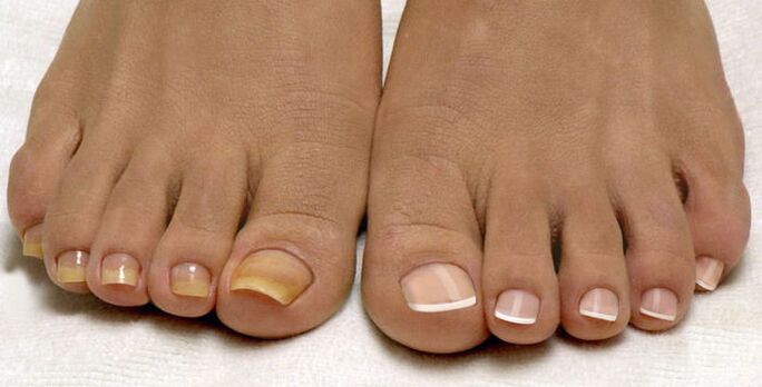 toenails and healthy nails affected by the fungus