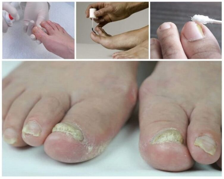 cure tools for toenail fungus