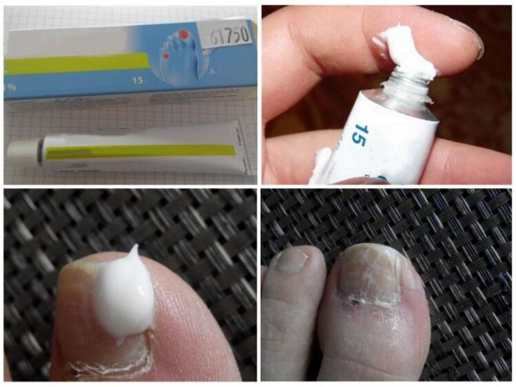 ointment against toenail fungus