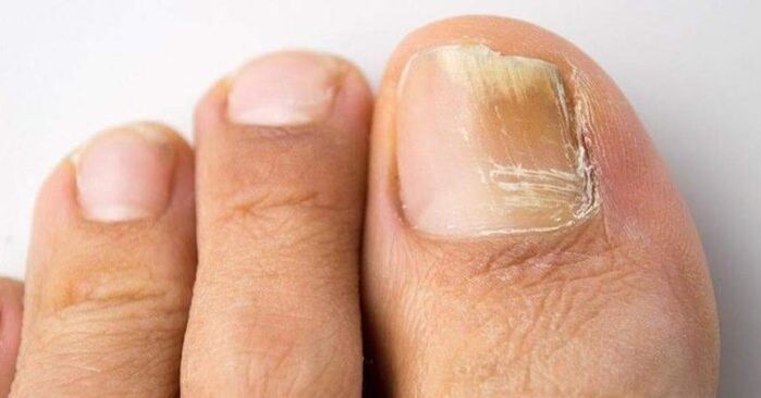 yellow toenails with fungal infection