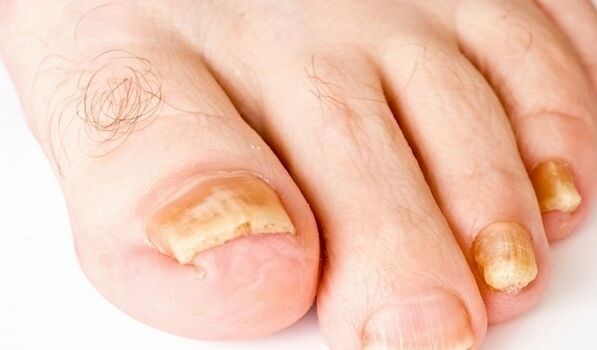 picture of toenail fungus symptoms