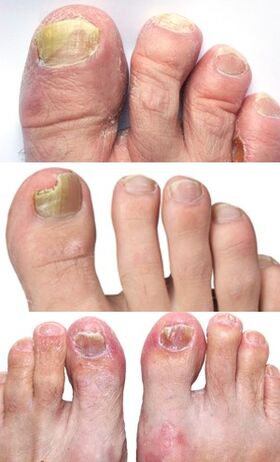 picture of toenail fungus