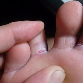 cracks between toenail fungus symptoms